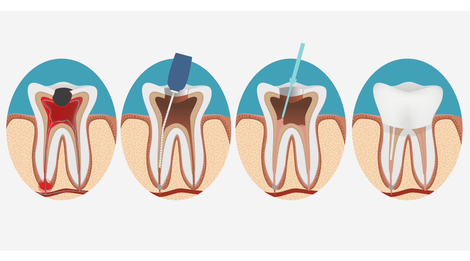 root canal therapy Whitby Ontario